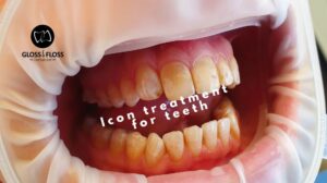 Tänder med vita fläckar innan ICON-behandling hos Gloss & Floss Dental Care